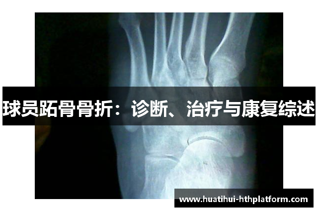 球员跖骨骨折：诊断、治疗与康复综述